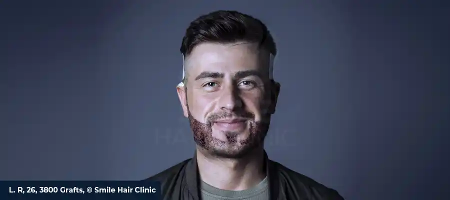 Beard Transplant Turkey