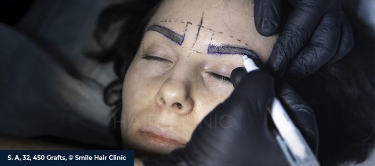 Who Is a Good Candidate for an Eyebrow Transplant