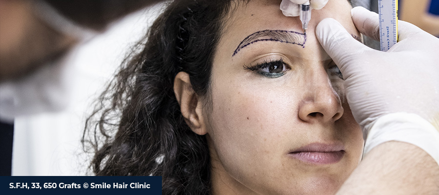 Eyebrow Transplant