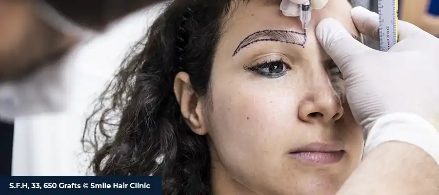 Eyebrow Transplant Turkey