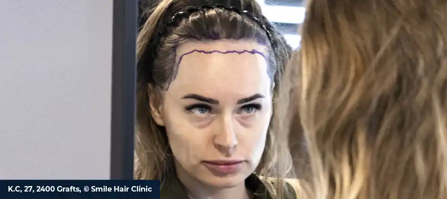 Female Hair Transplant