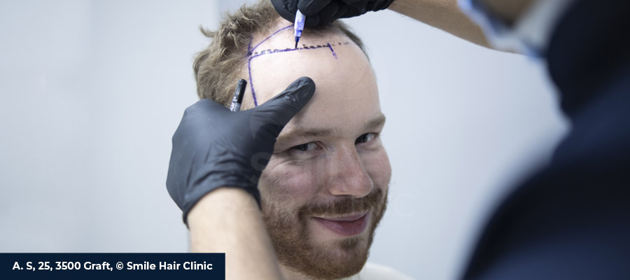 Hair Transplant