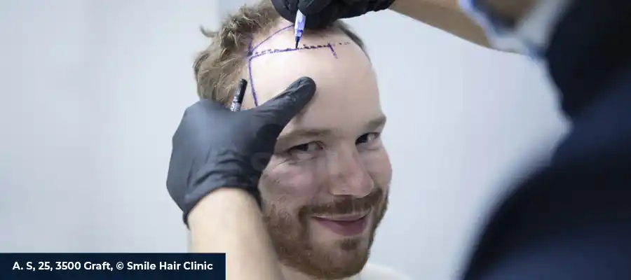 Hair Transplant Turkey