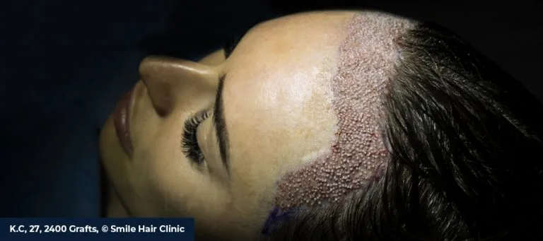 What Is a Female Hair Transplant