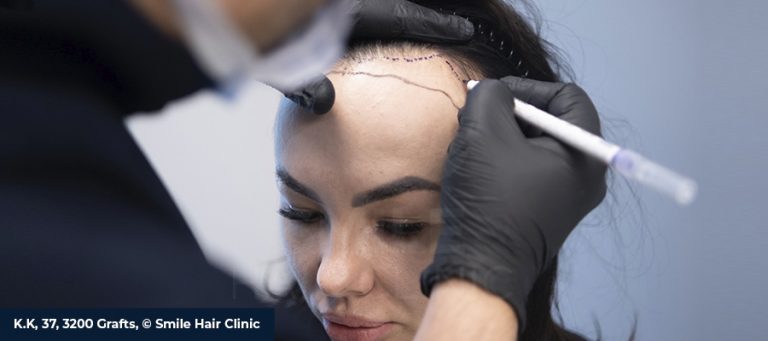 Who Is a Good Candidate for a Female Hair Transplant