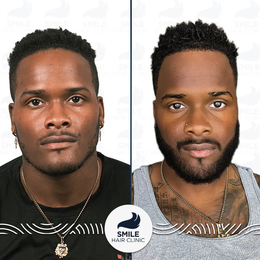 Is an Afro Hair Transplant Permanent