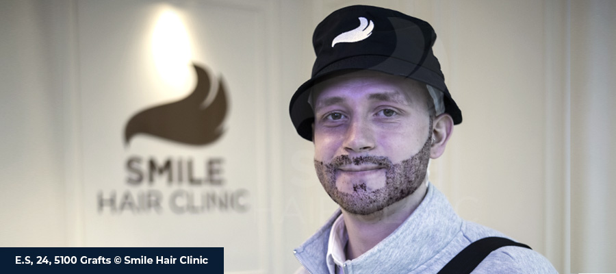 Moustache Transplant