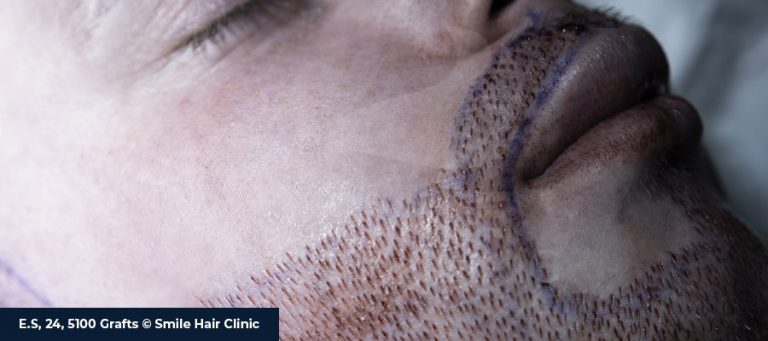 Process of Mustache Transplantation