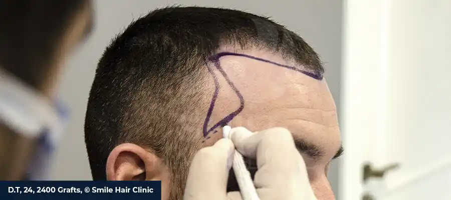 sideburn restoration
