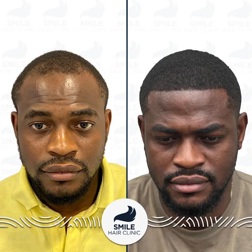 What Is an Afro Hair Transplant