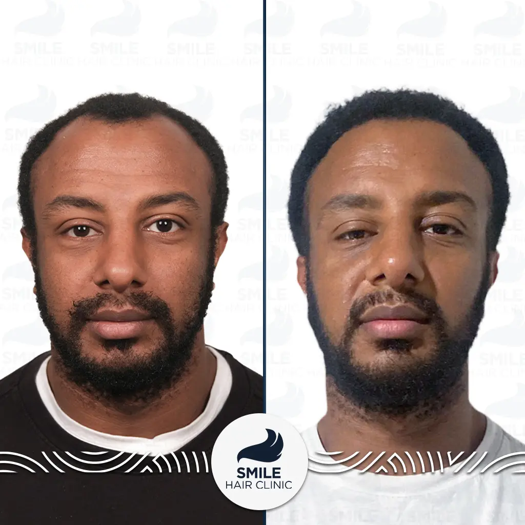 Who Is a Good Candidate for an Afro Hair Transplant