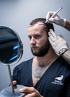 hair-transplant