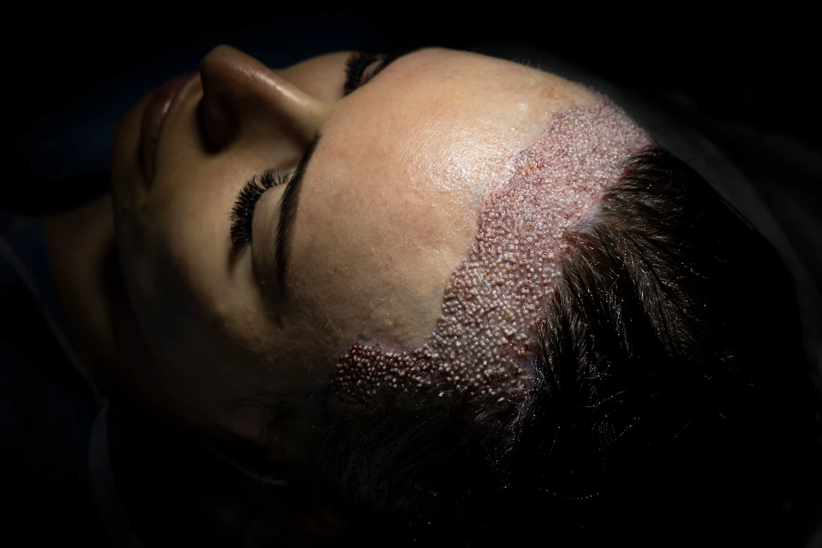 Female Hair Loss: Causes, Patterns and When a Transplant