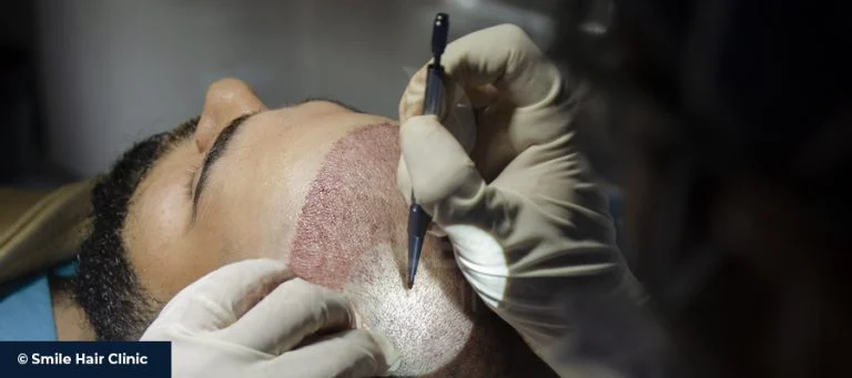 Manual FUE Hair Transplant