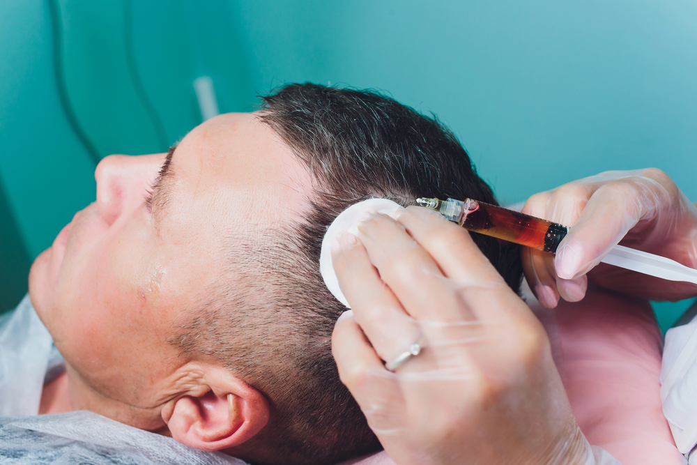 Who Is a Good Candidate for PRP Hair Treatment