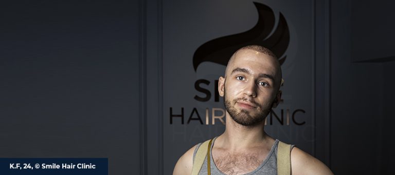 Body Hair Transplant