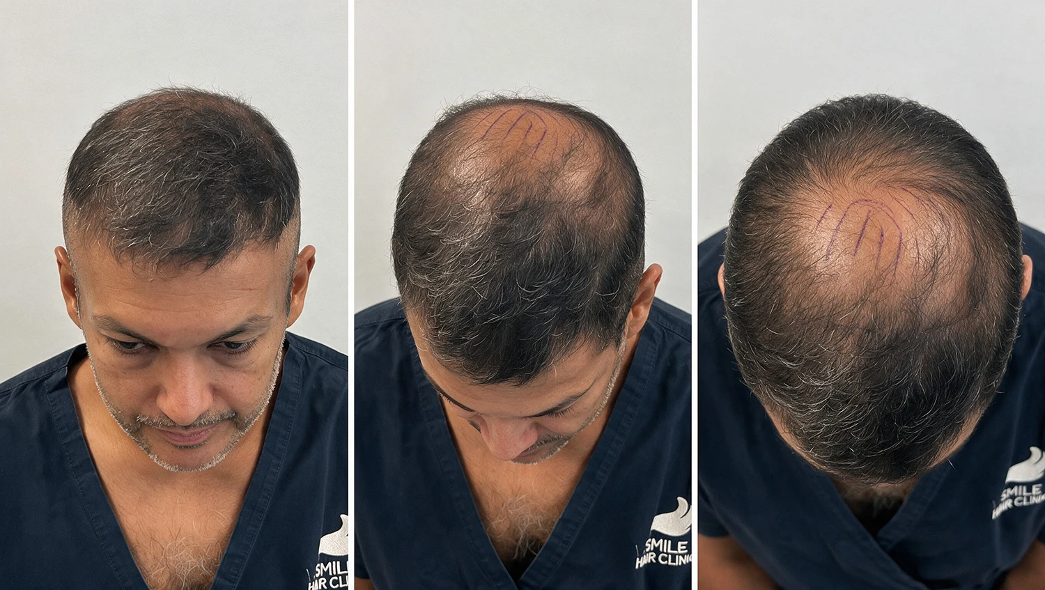 how to tell if your crown is thinning