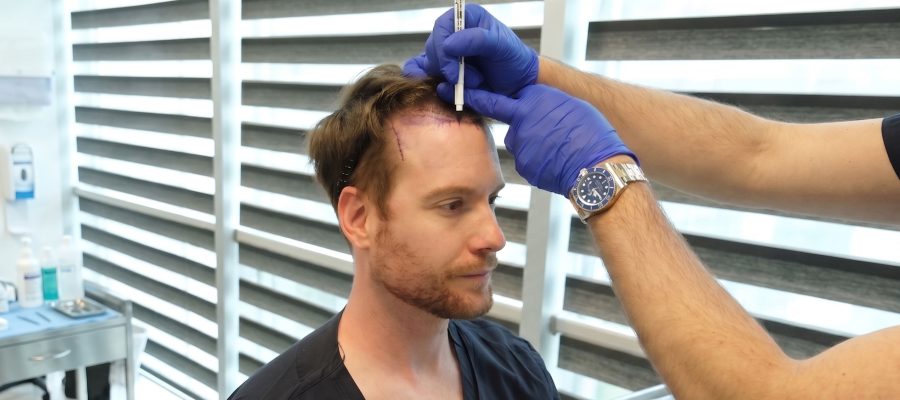 long fue hair transplant