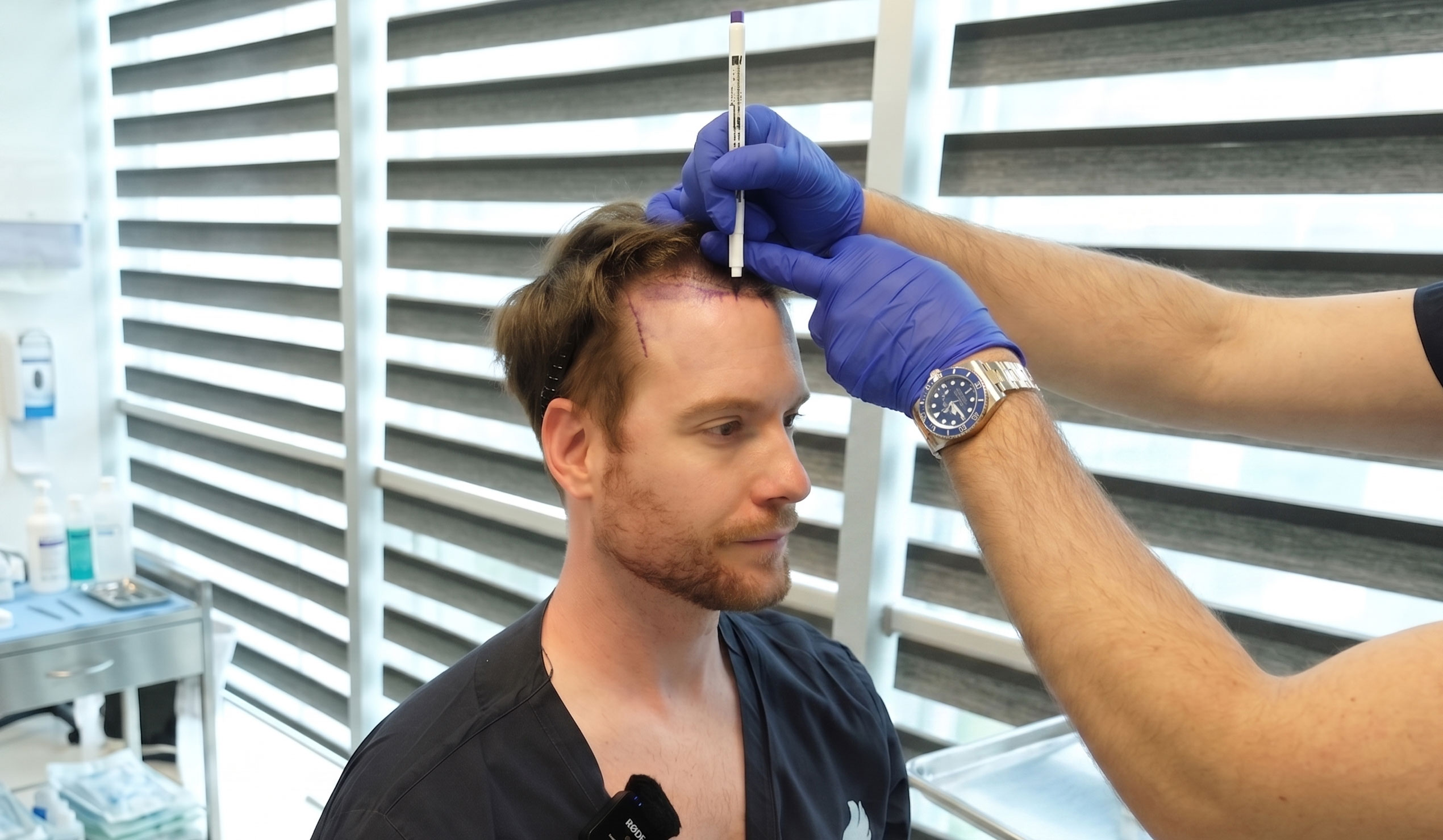 Long FUE Hair Transplant