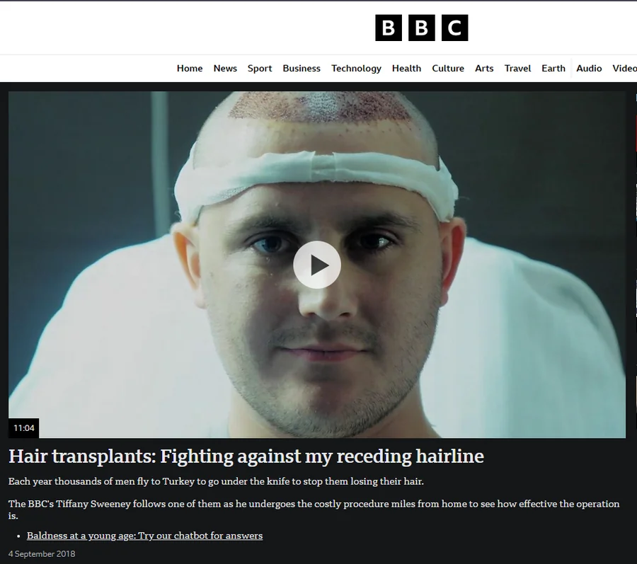 BBC News video on a British patient travelling to Turkey for a hair transplant