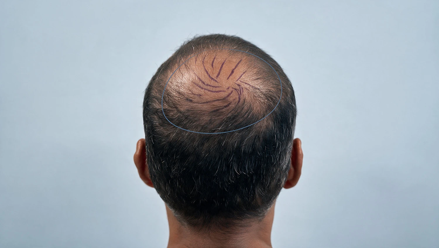 Bald Spot on the Crown: Causes and Your Treatment Options